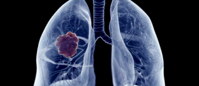 肺癌个性化用药解决方案
